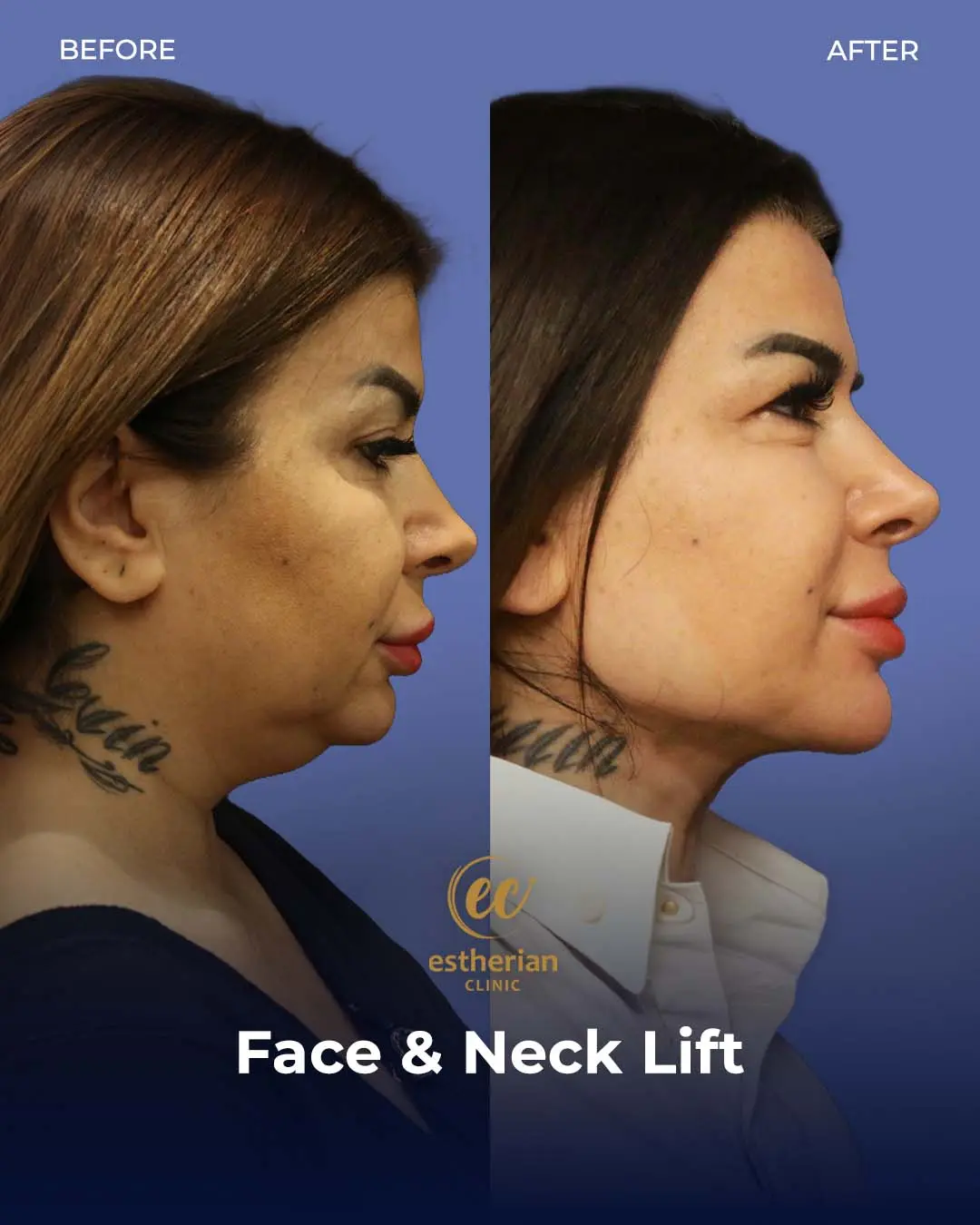 Face and Neck Lift Before and After Gallery by the Estherian Clinic