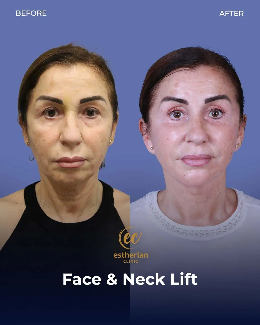 Face and Neck Lift Before and After Gallery by the Estherian Clinic