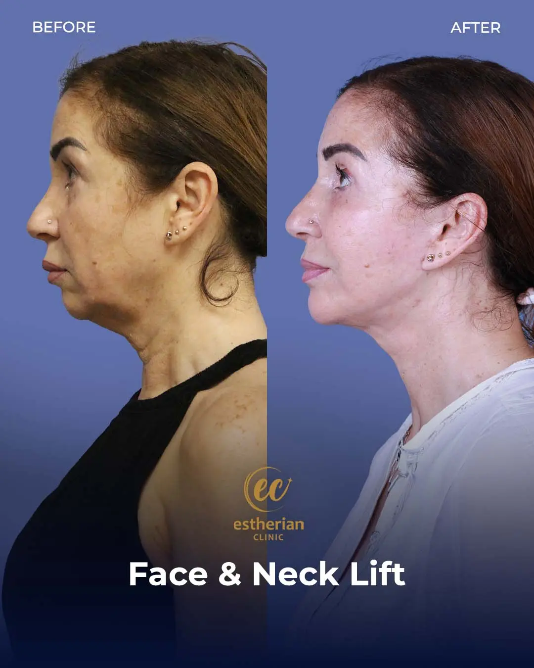 Face and Neck Lift Before and After Gallery by the Estherian Clinic