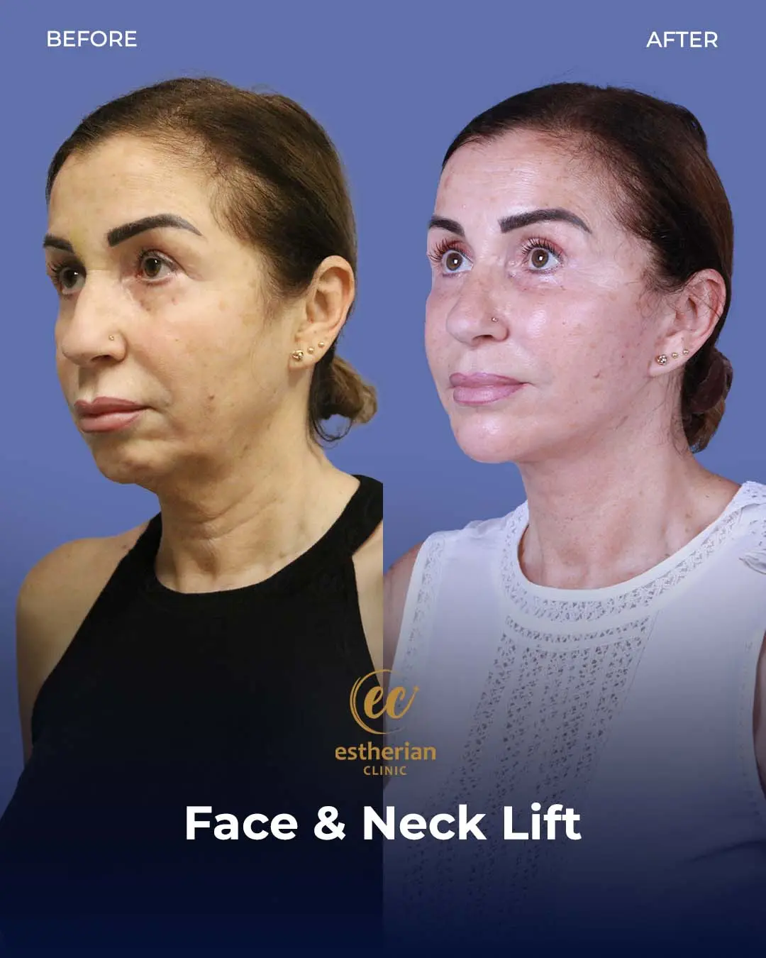 Face and Neck Lift Before and After Gallery by the Estherian Clinic