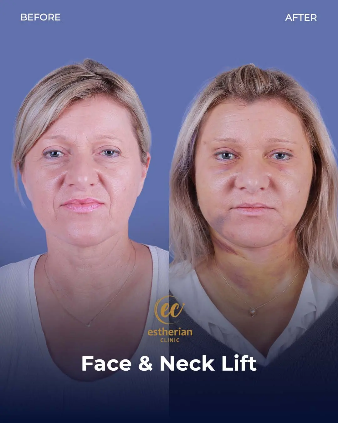 Face and Neck Lift Before and After Gallery by the Estherian Clinic