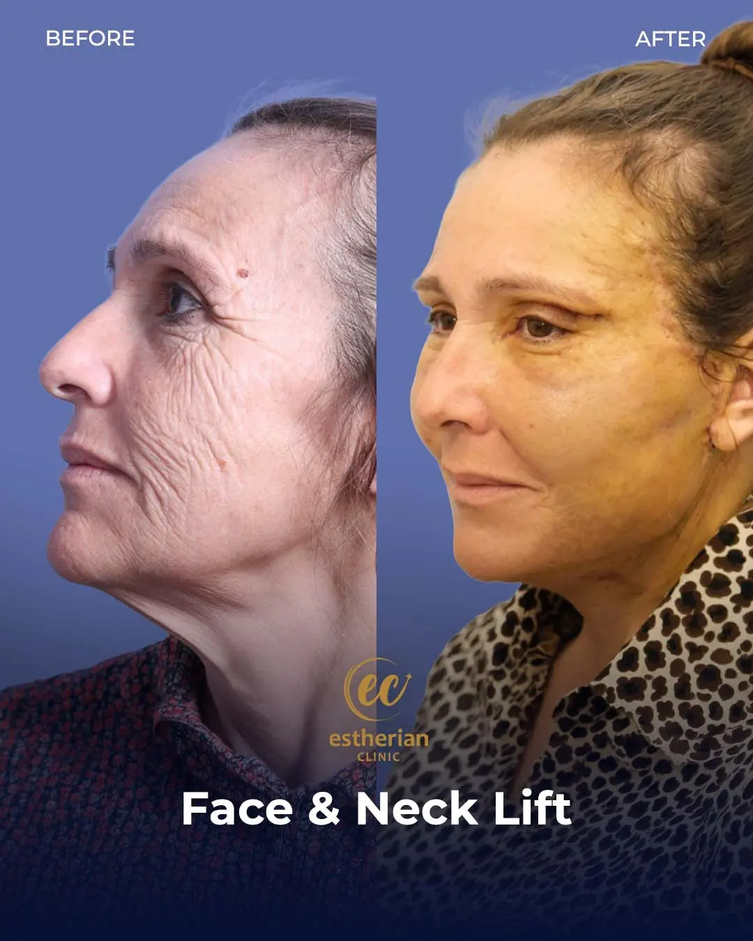 Face and Neck Lift Before and After Gallery by the Estherian Clinic