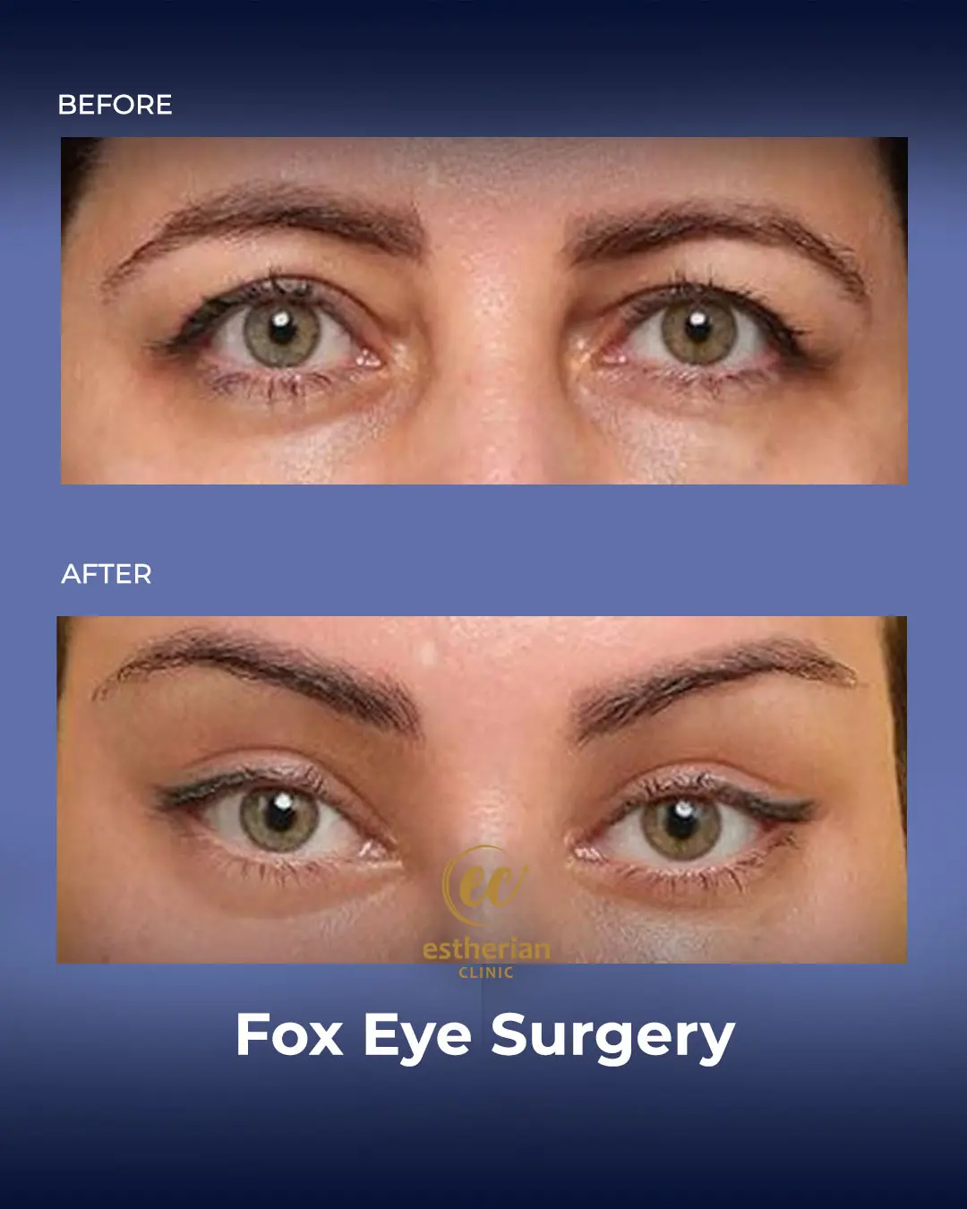 Fox Eye Surgery Results by the Estherian Clinic
