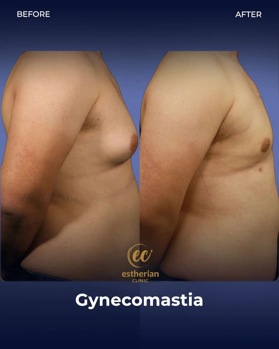 Gynecomastia before and after transformation by the Estherian Clinic