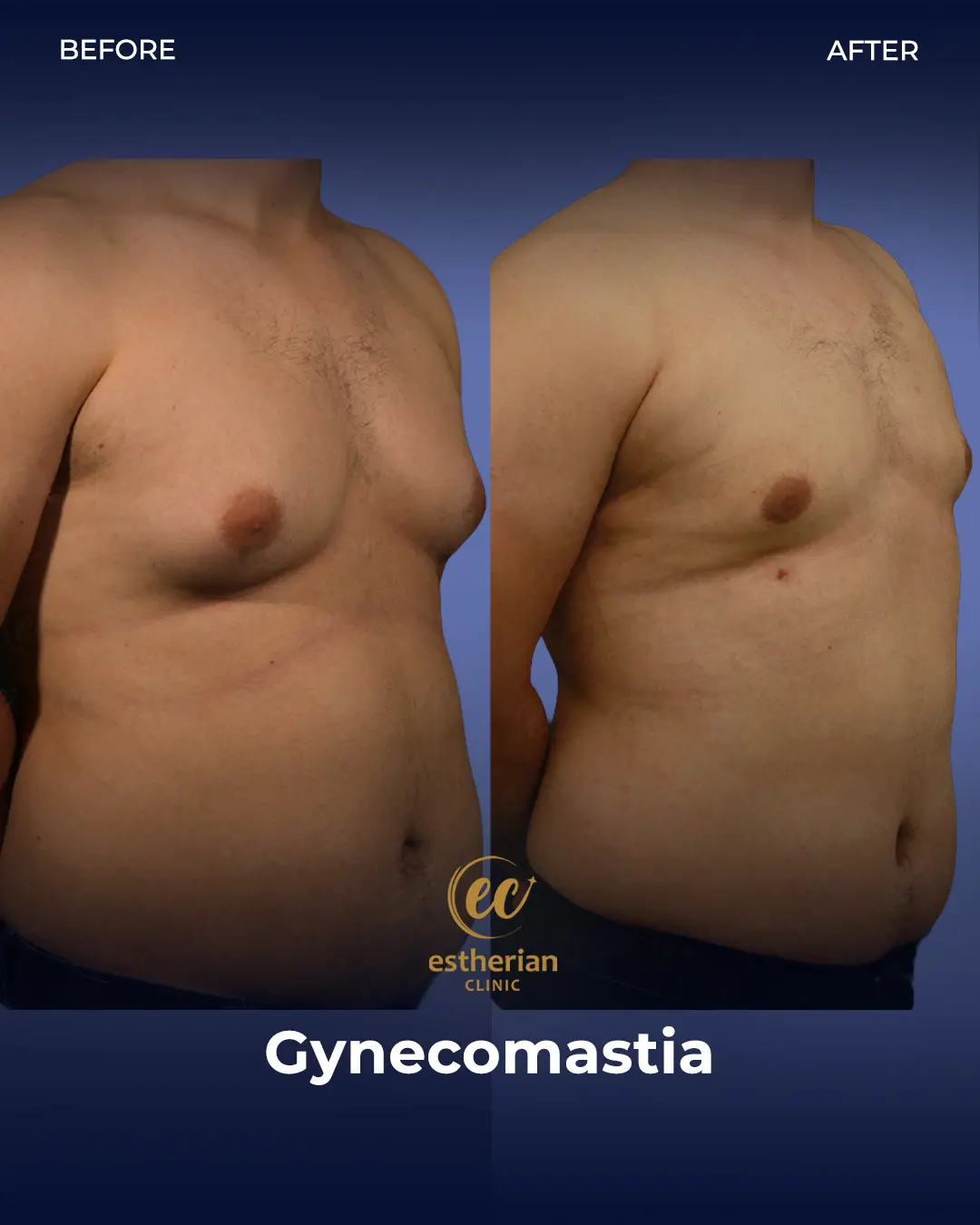 Gynecomastia before and after transformation by the Estherian Clinic