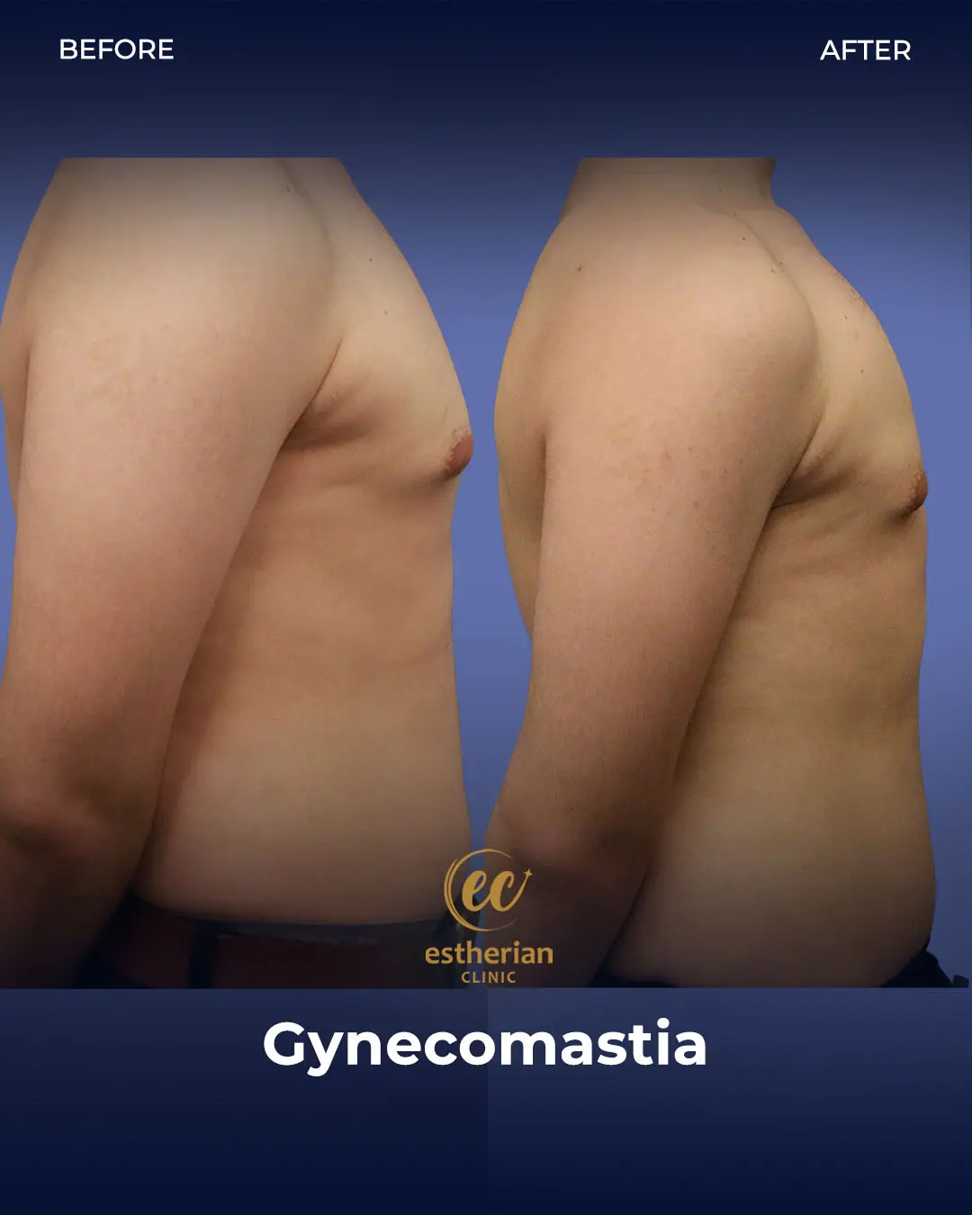 Gynecomastia before and after transformation by the Estherian Clinic