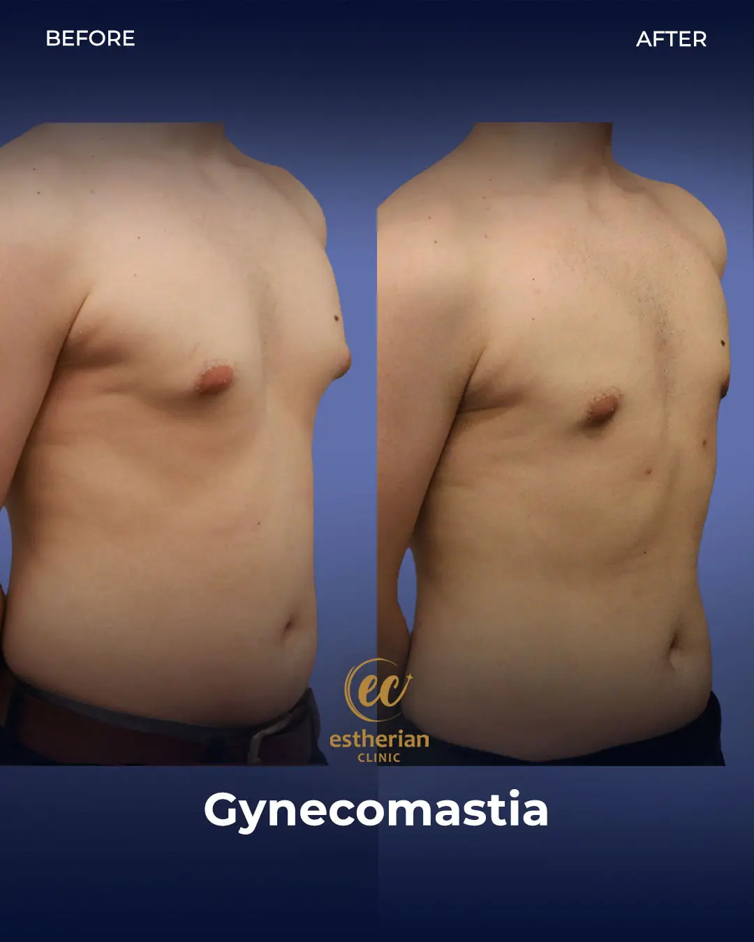 Gynecomastia before and after transformation by the Estherian Clinic