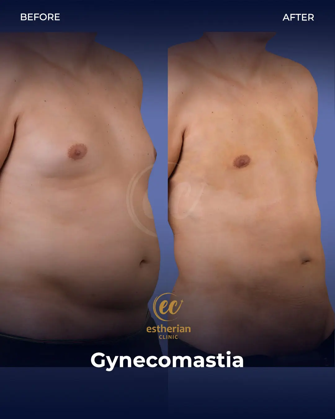 Gynecomastia before and after transformation by the Estherian Clinic