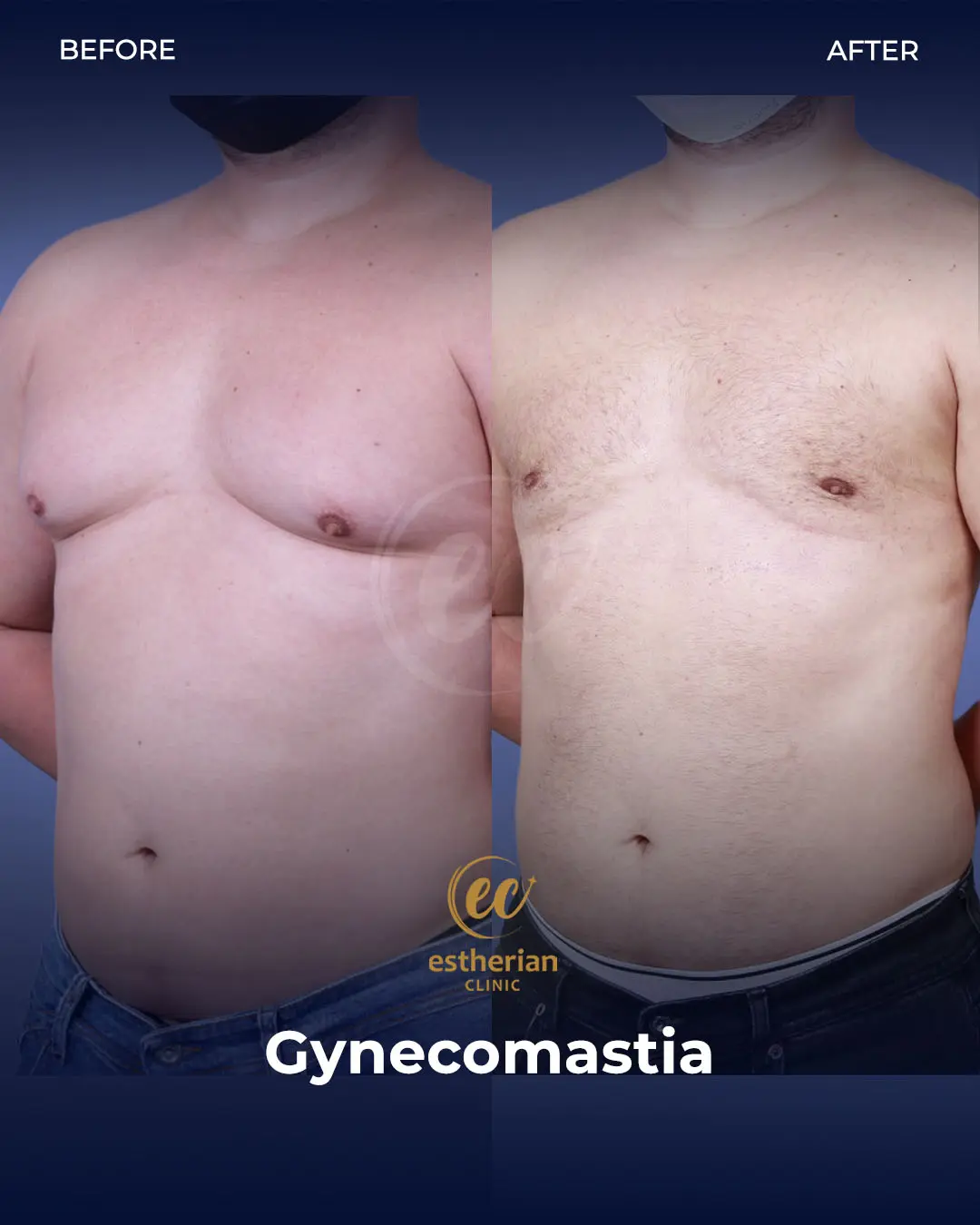 Gynecomastia before and after transformation by the Estherian Clinic