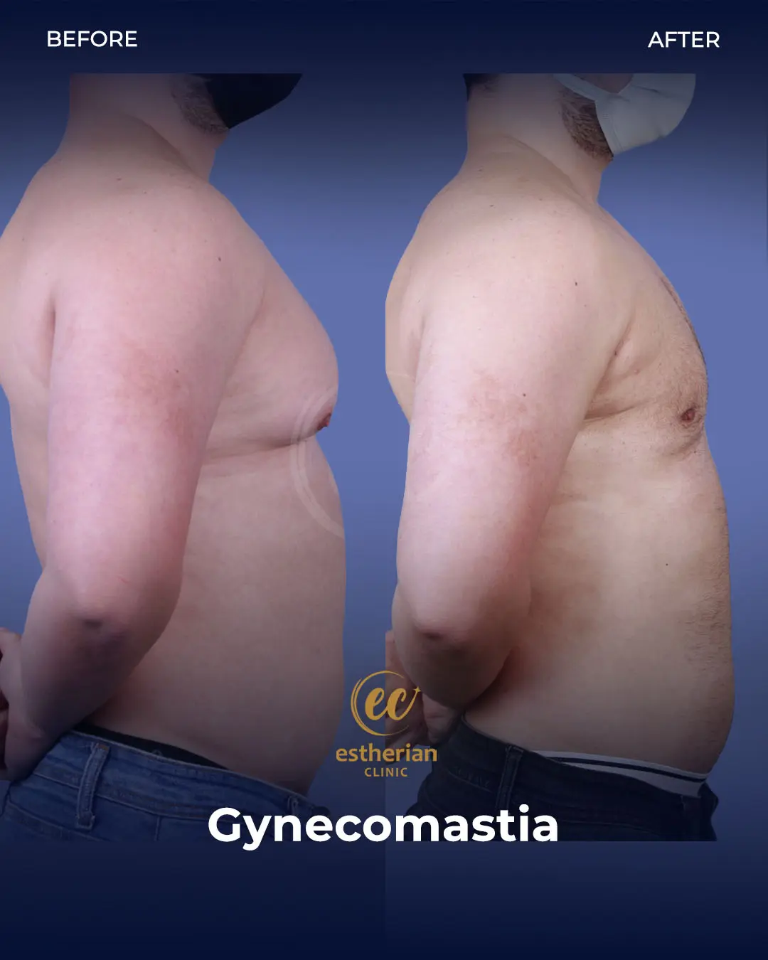 Gynecomastia before and after transformation by the Estherian Clinic