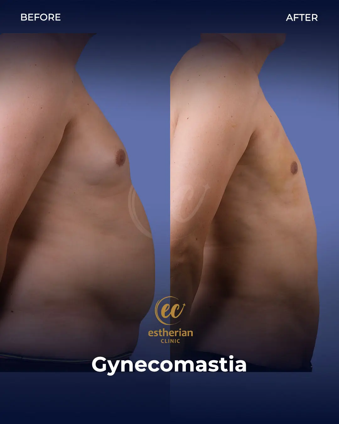 Gynecomastia before and after transformation by the Estherian Clinic