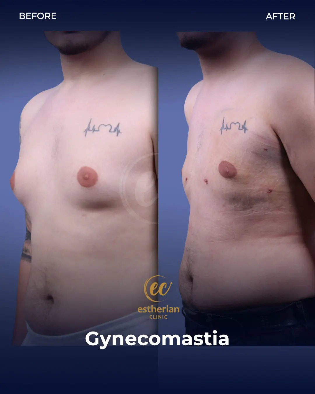 Gynecomastia before and after transformation by the Estherian Clinic