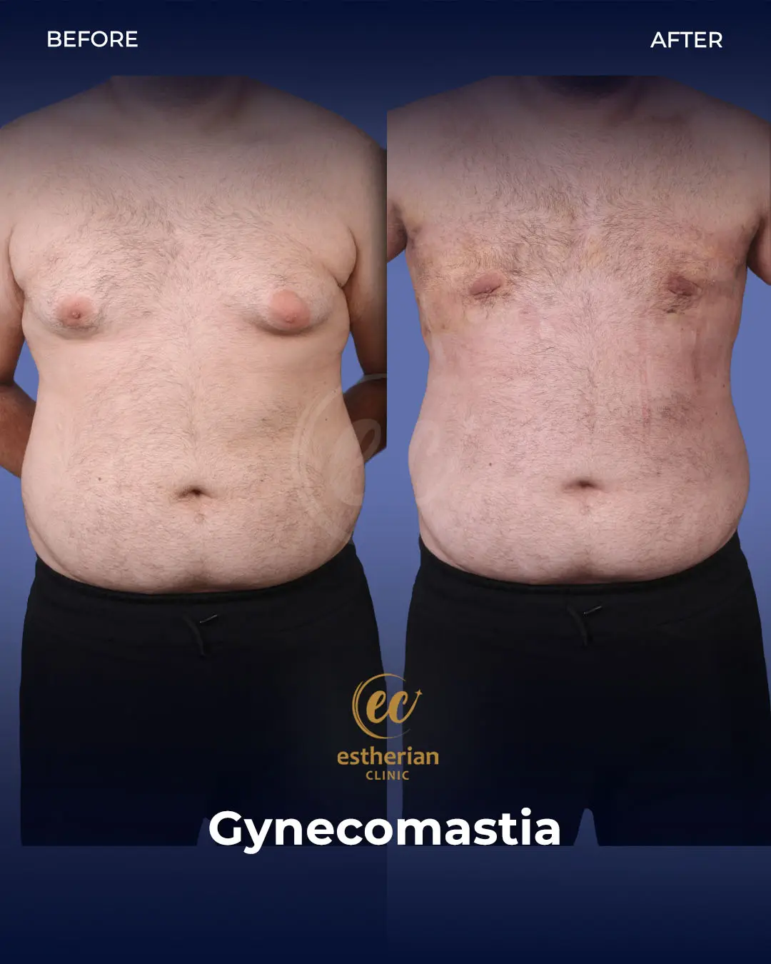 Gynecomastia before and after transformation by the Estherian Clinic