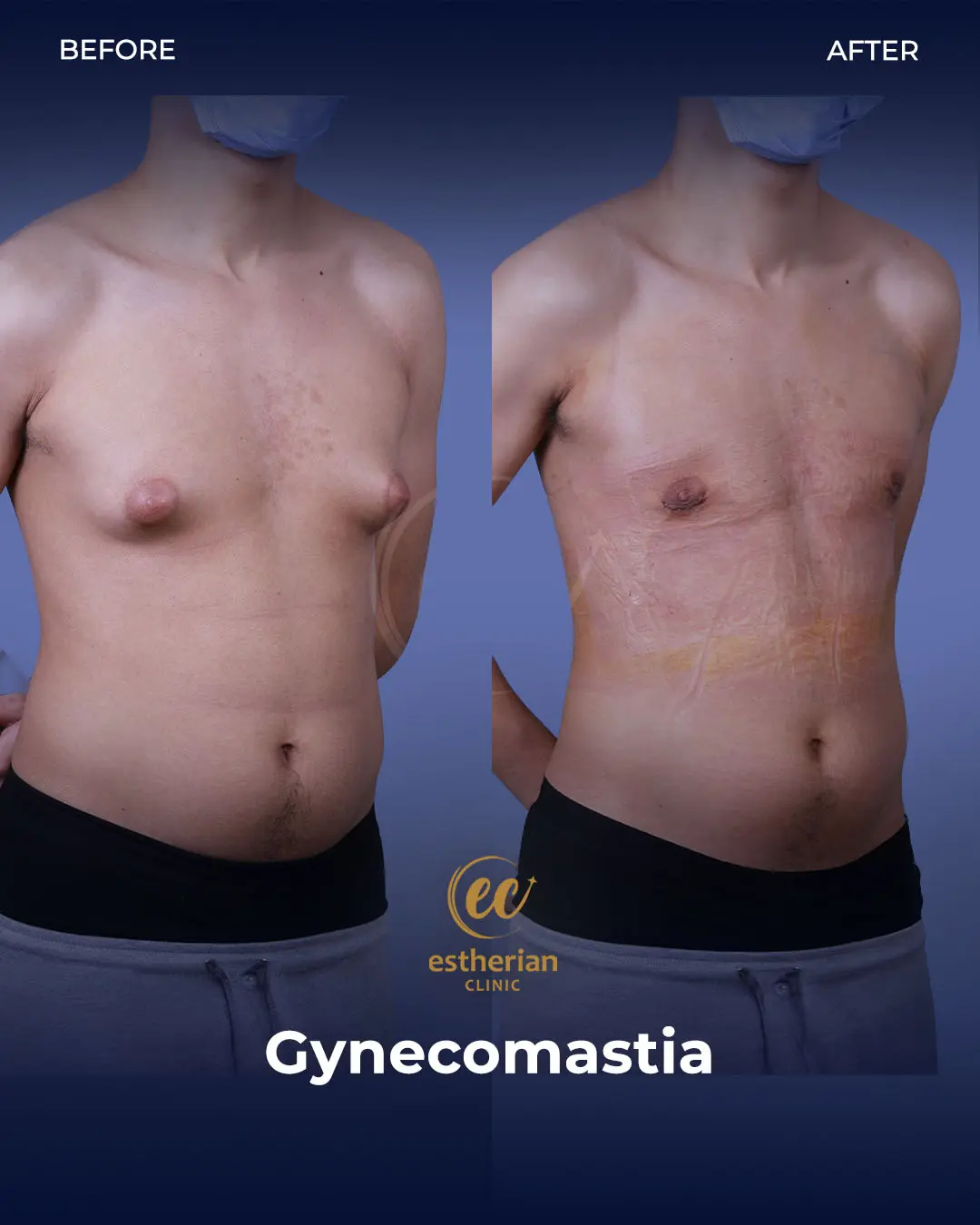 Gynecomastia before and after transformation by the Estherian Clinic