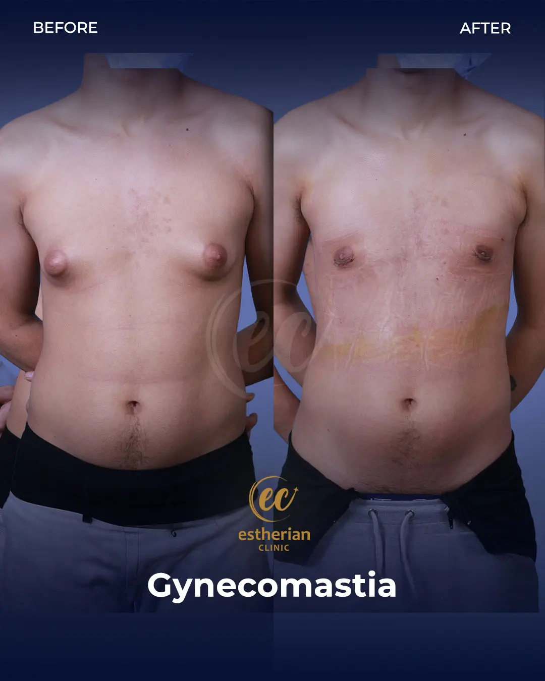 Gynecomastia before and after transformation by the Estherian Clinic