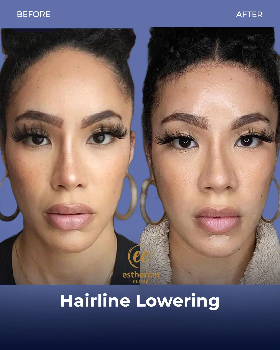 Hairline Lowering Surgery Before and After Transformation by the Estherian Clinic