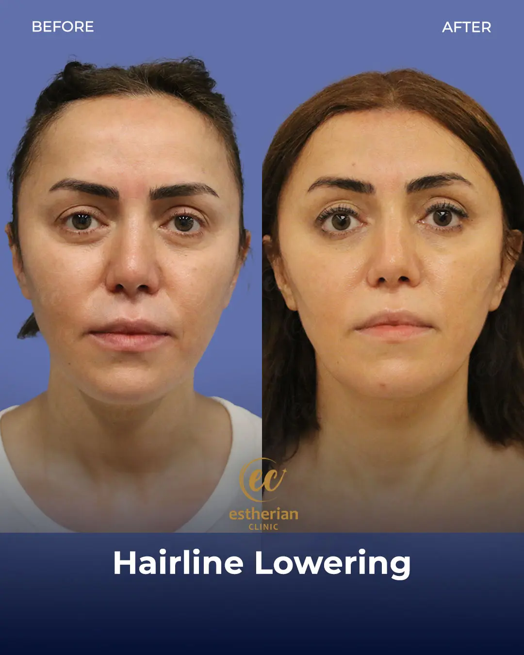 Hairline Lowering Surgery Before and After Transformation by the Estherian Clinic