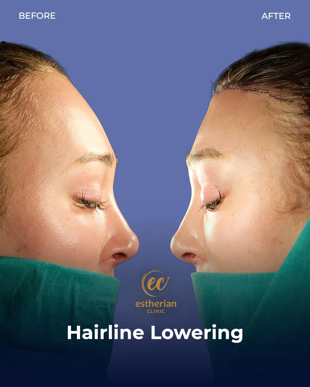 Hairline Lowering Surgery Before and After Transformation by the Estherian Clinic