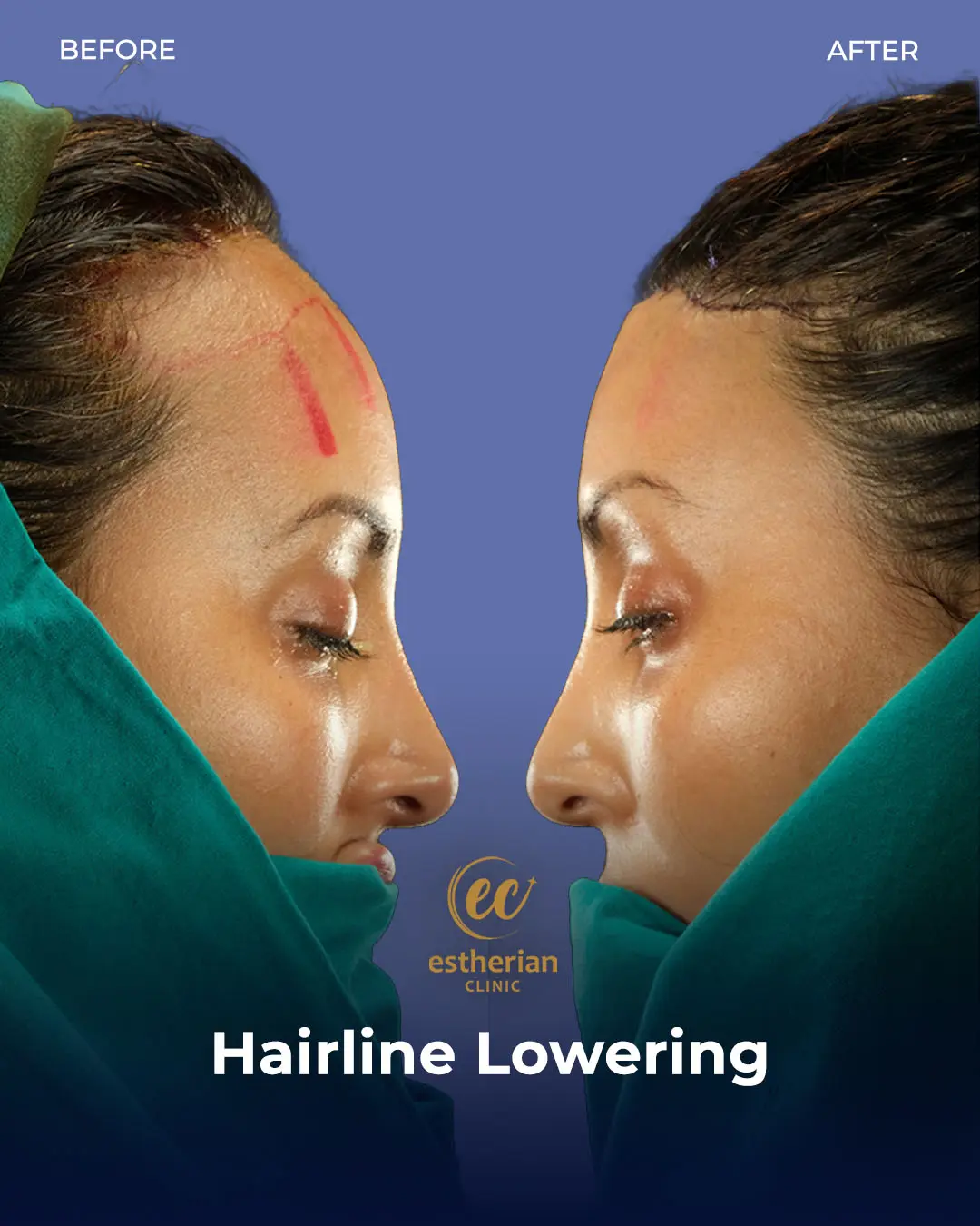 Hairline Lowering Surgery Before and After Transformation by the Estherian Clinic