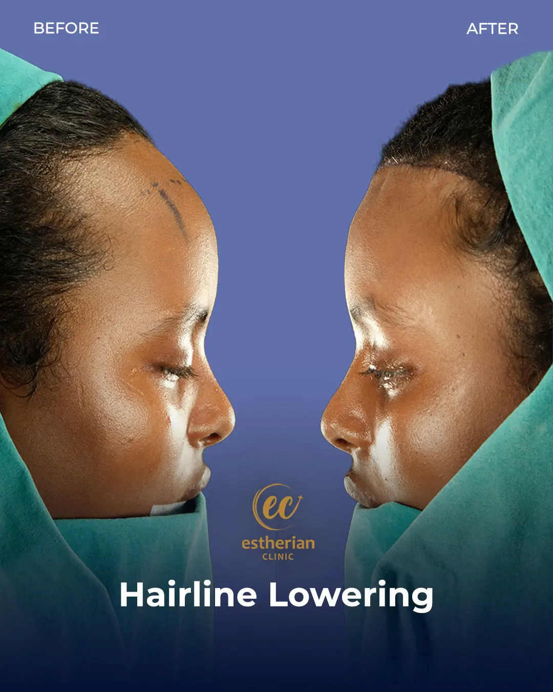 Hairline Lowering Surgery Before and After Transformation by the Estherian Clinic