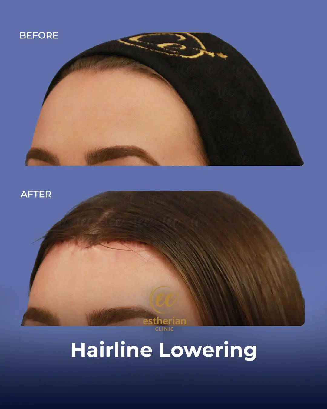 Hairline Lowering Surgery Before and After Transformation by the Estherian Clinic