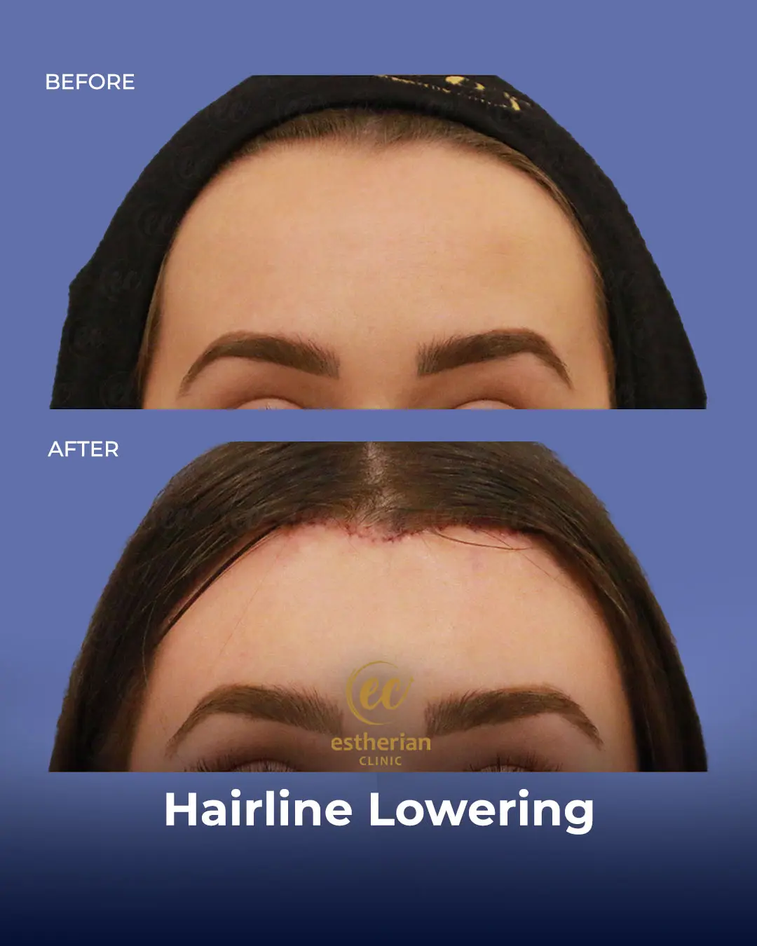 Hairline Lowering Surgery Before and After Transformation by the Estherian Clinic