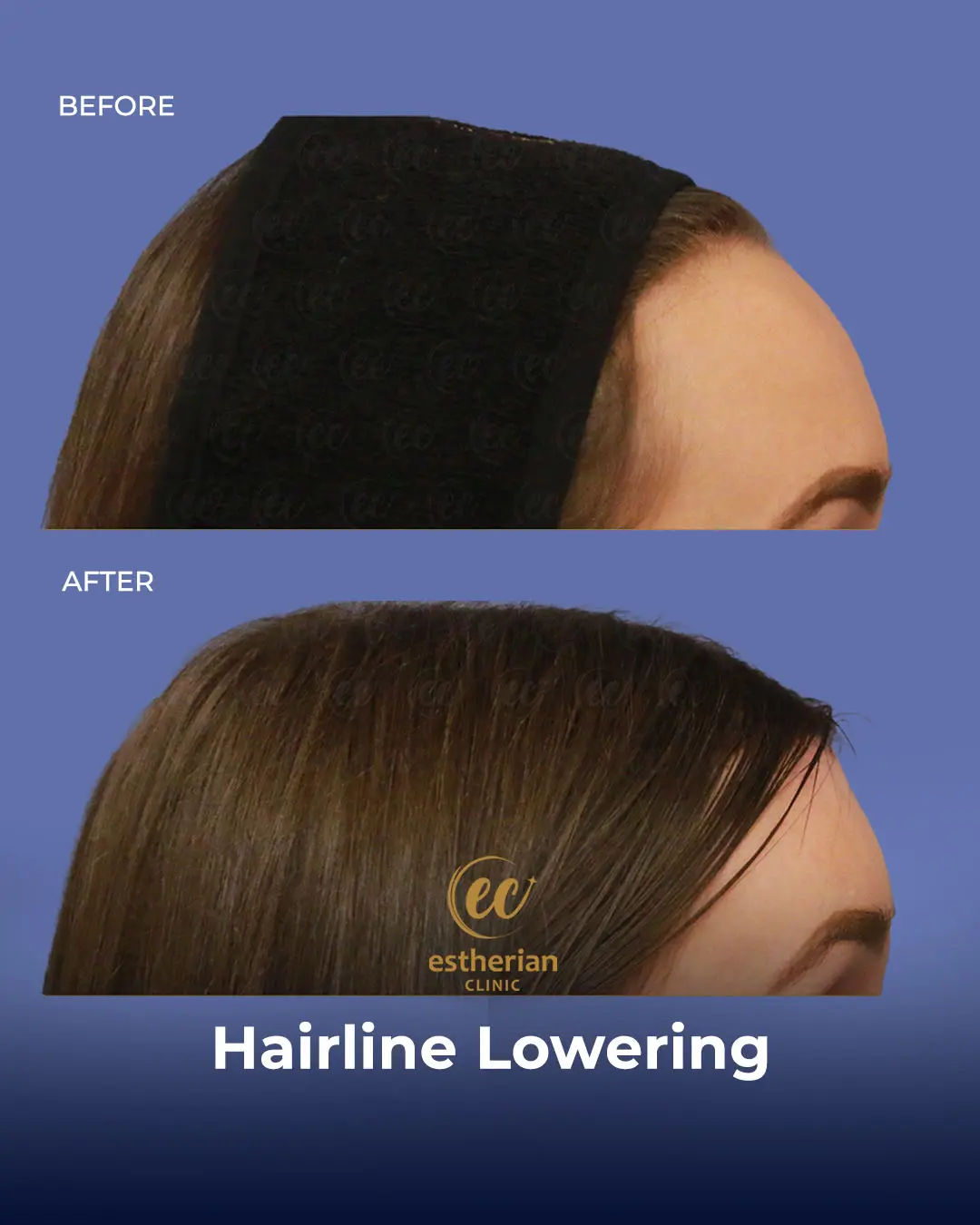 Hairline Lowering Surgery Before and After Transformation by the Estherian Clinic