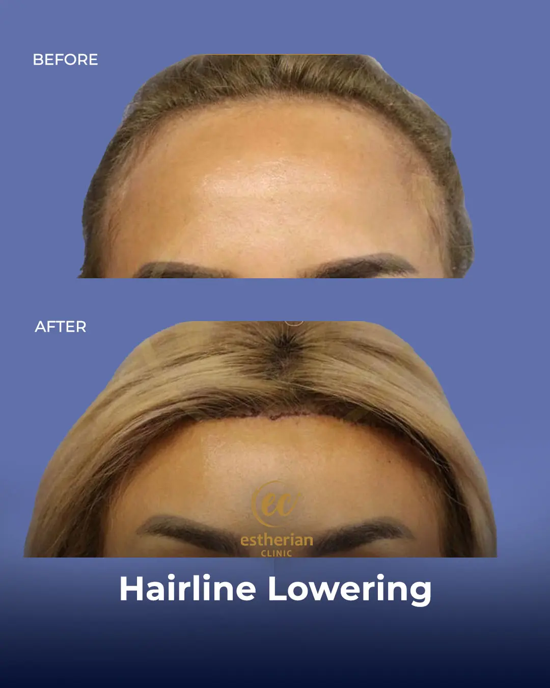 Hairline Lowering Surgery Before and After Transformation by the Estherian Clinic