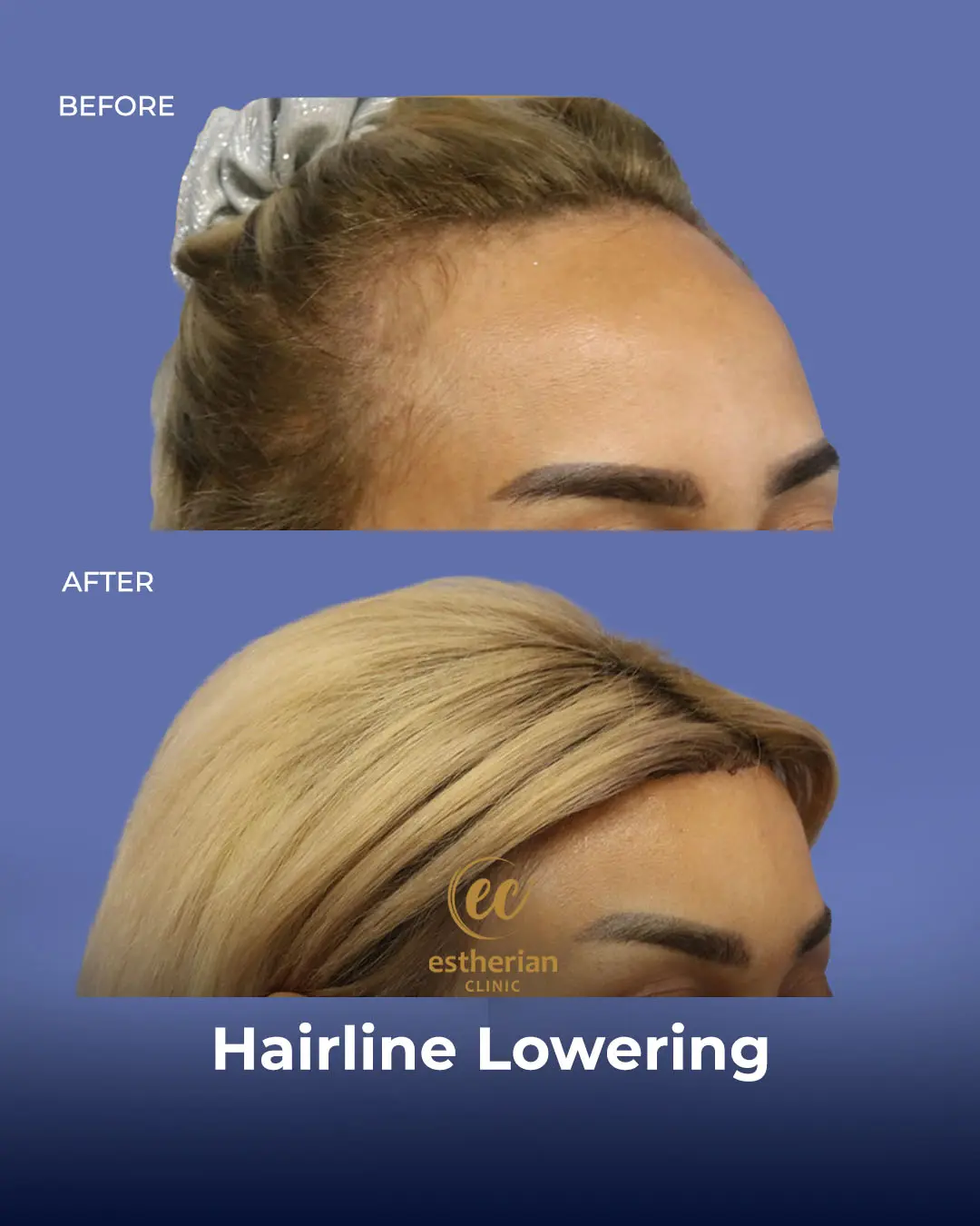 Hairline Lowering Surgery Before and After Transformation by the Estherian Clinic