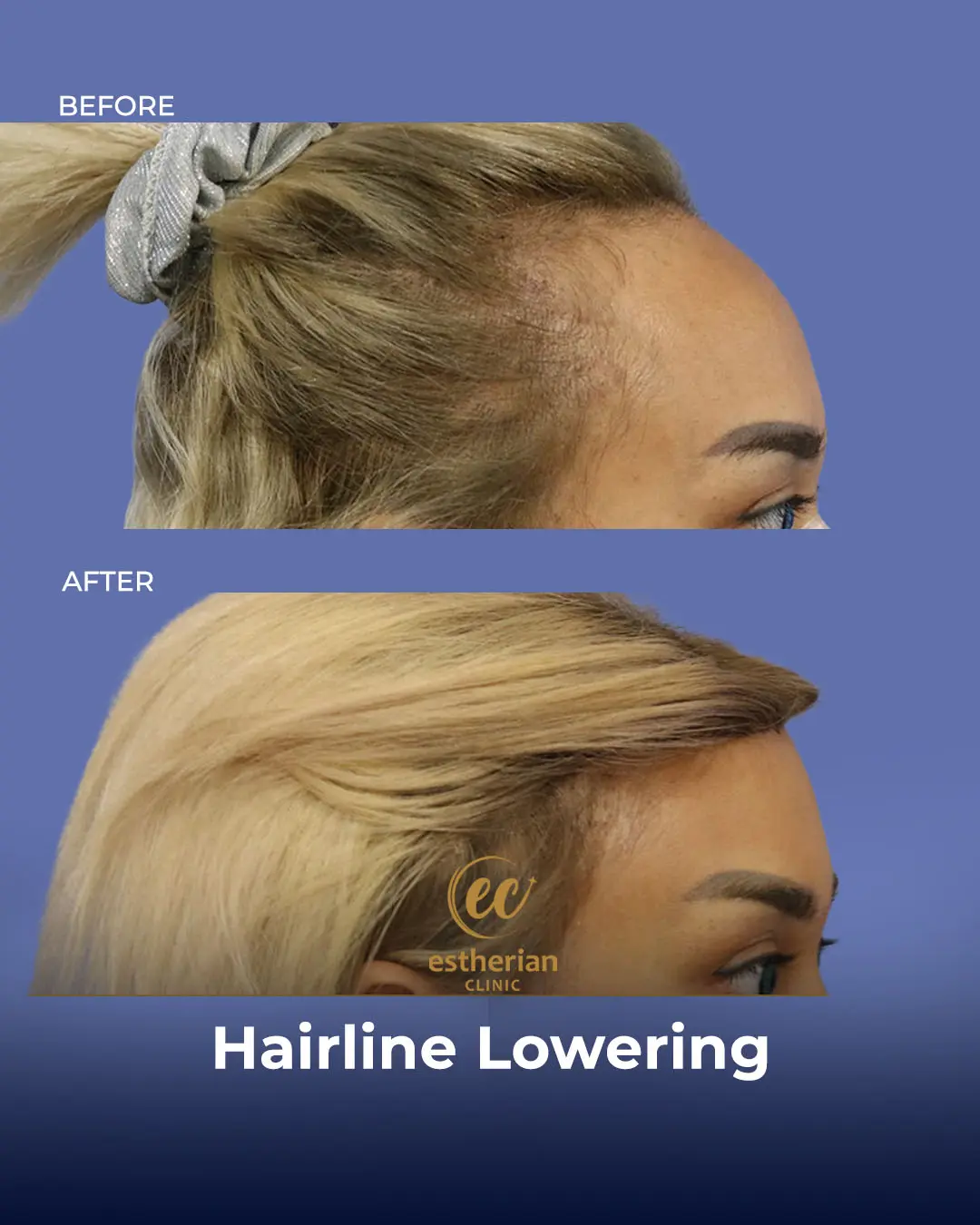 Hairline Lowering Surgery Before and After Transformation by the Estherian Clinic