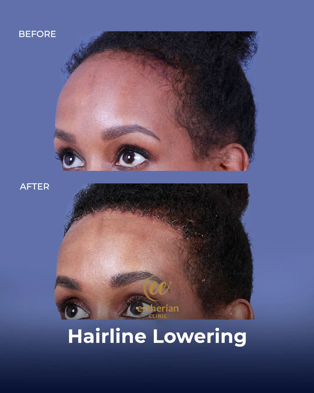Hairline Lowering Surgery Before and After Transformation by the Estherian Clinic