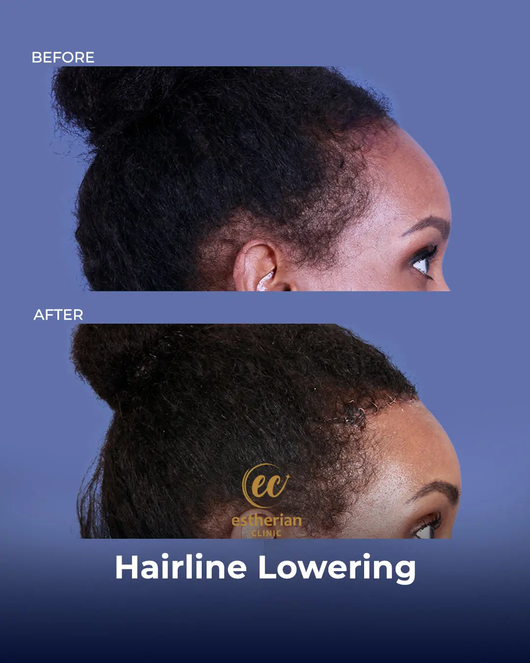 Hairline Lowering Surgery Before and After Transformation by the Estherian Clinic