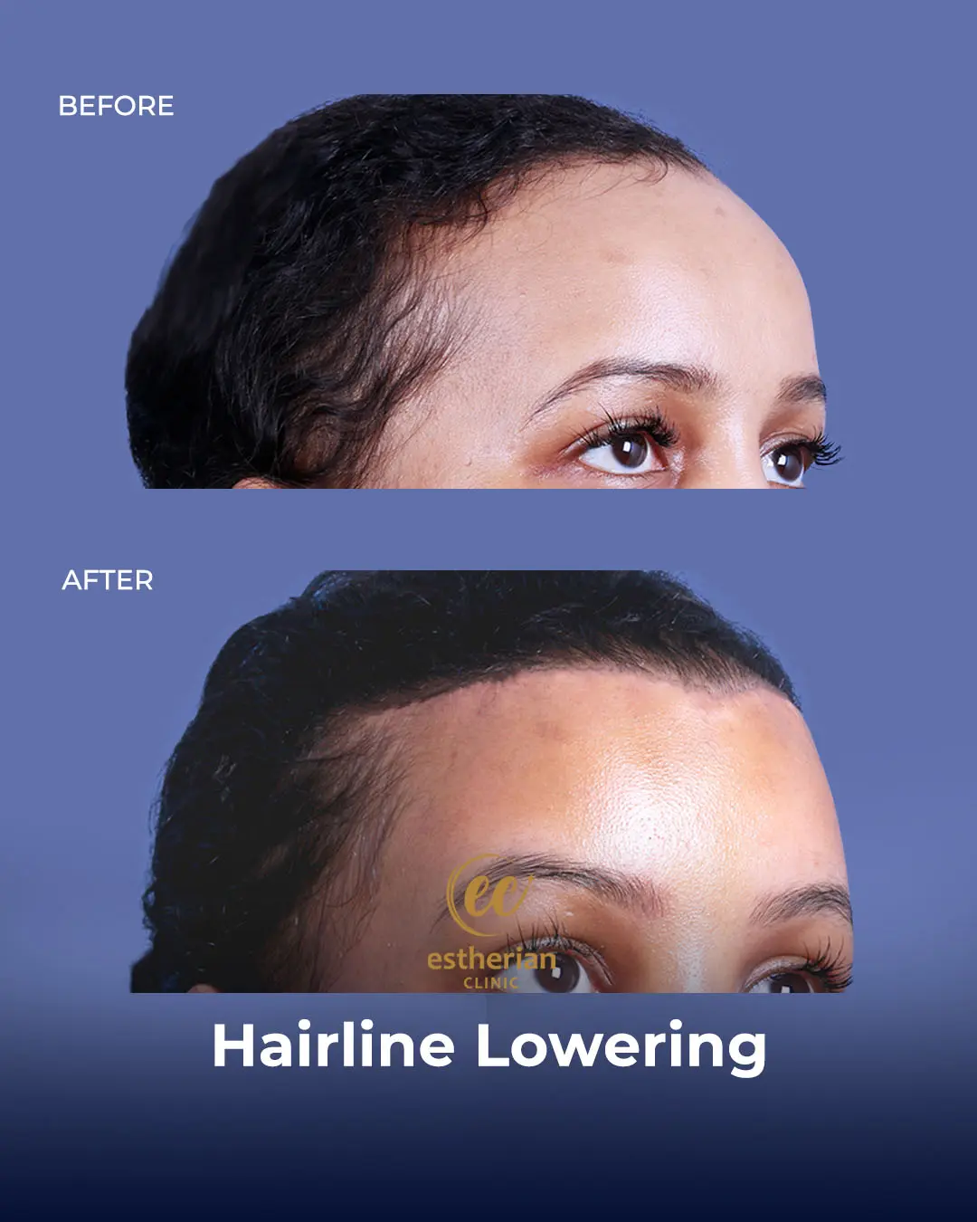 Hairline Lowering Surgery Before and After Transformation by the Estherian Clinic