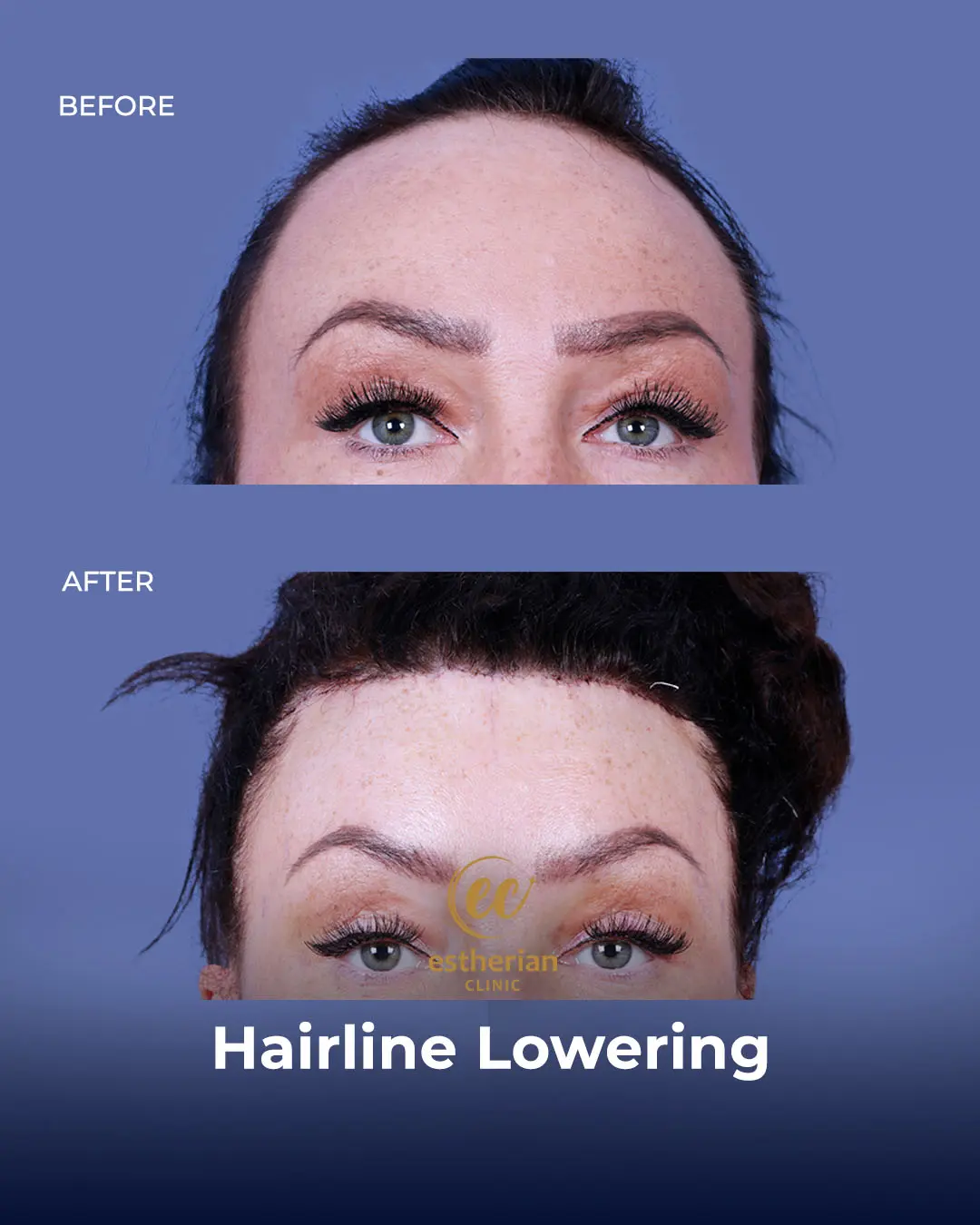 Hairline Lowering Surgery Before and After Transformation by the Estherian Clinic
