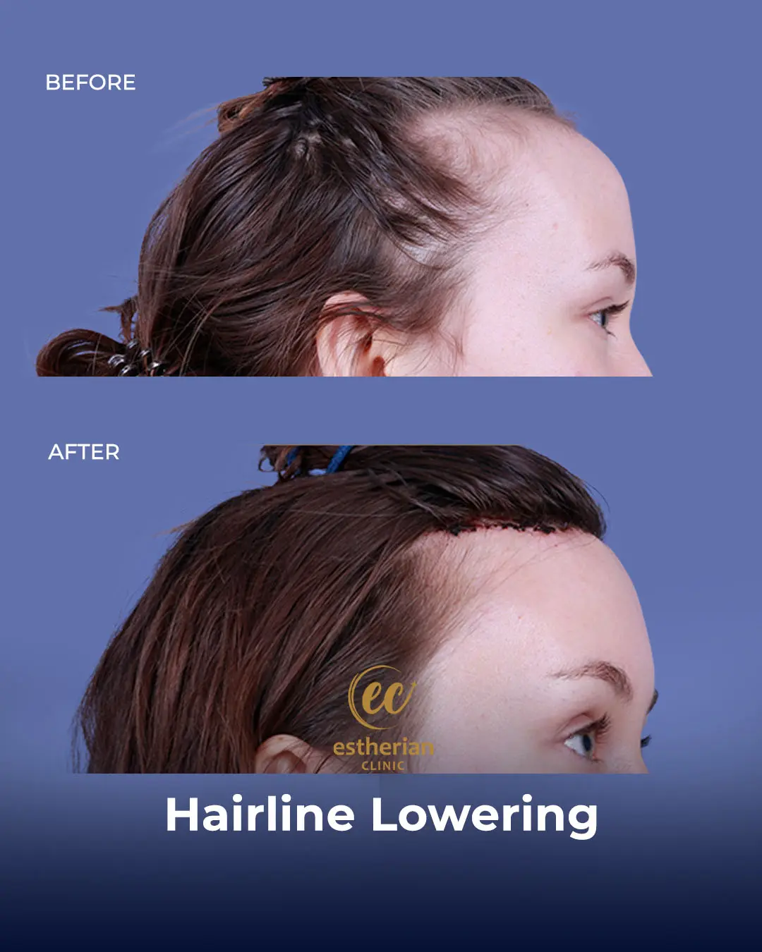 Hairline Lowering Surgery Before and After Transformation by the Estherian Clinic