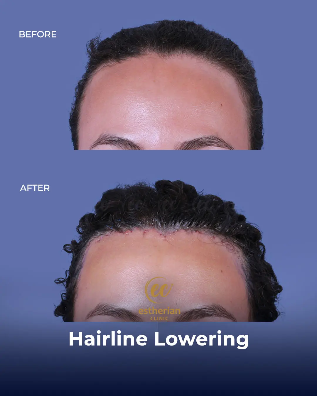 Hairline Lowering Surgery Before and After Transformation by the Estherian Clinic