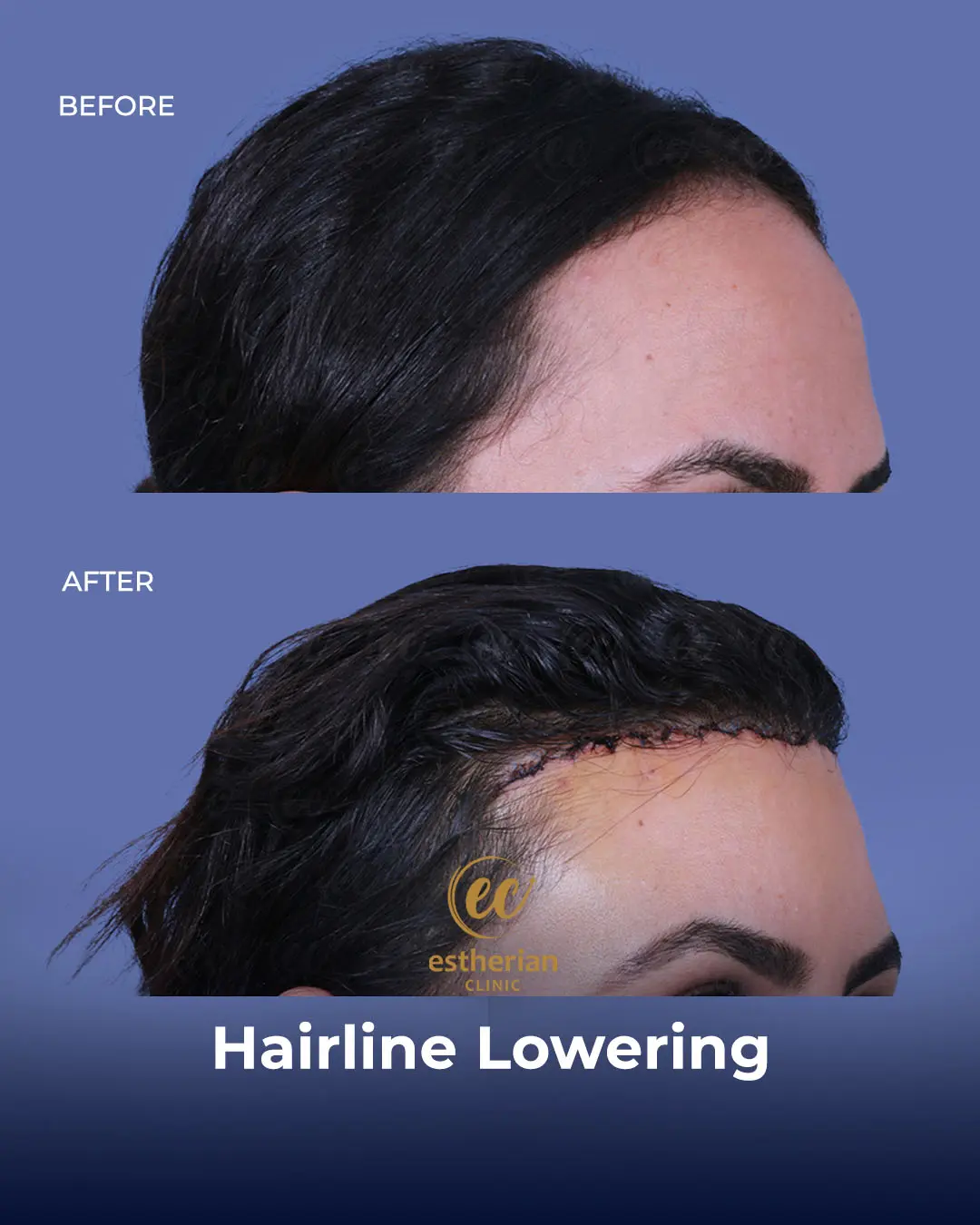 Hairline Lowering Surgery Before and After Transformation by the Estherian Clinic