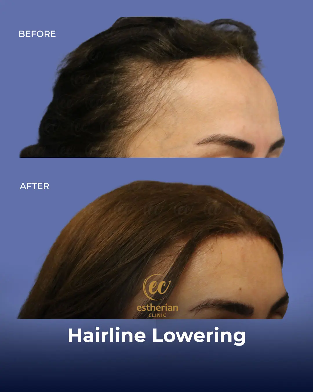 Hairline Lowering Surgery Before and After Transformation by the Estherian Clinic