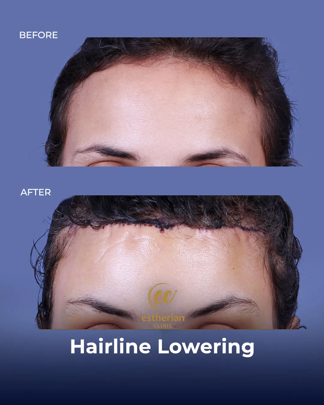 Hairline Lowering Surgery Before and After Transformation by the Estherian Clinic