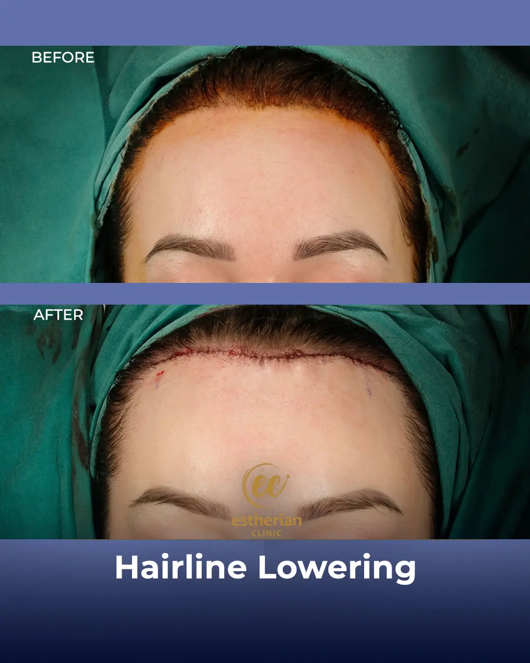 Hairline Lowering Surgery Before and After Transformation by the Estherian Clinic