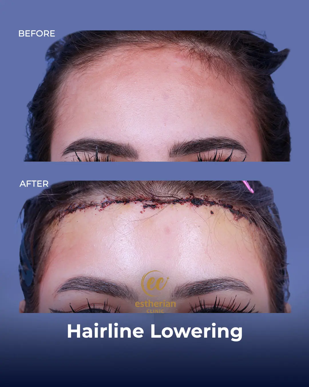Hairline Lowering Surgery Before and After Transformation by the Estherian Clinic
