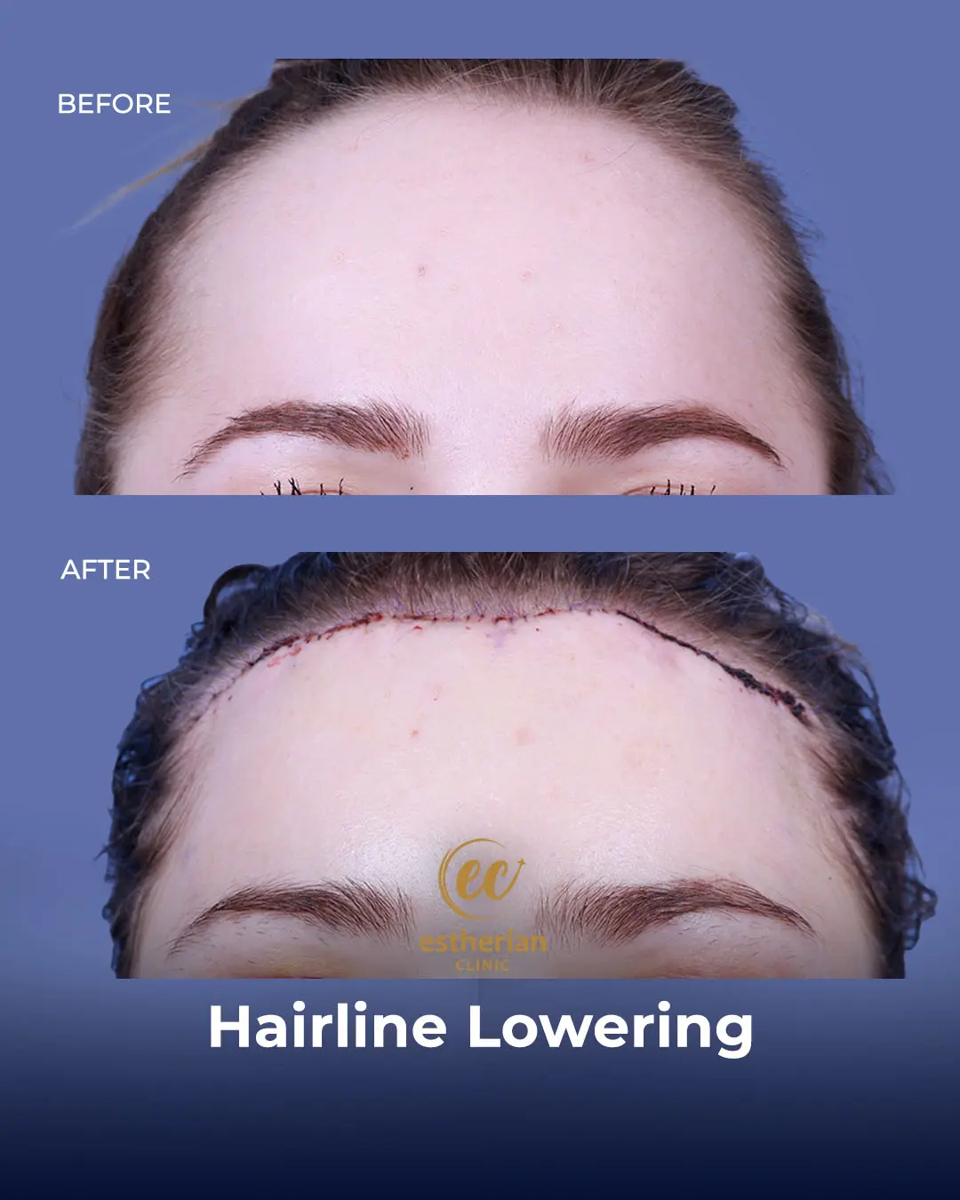 Hairline Lowering Surgery Before and After Transformation by the Estherian Clinic