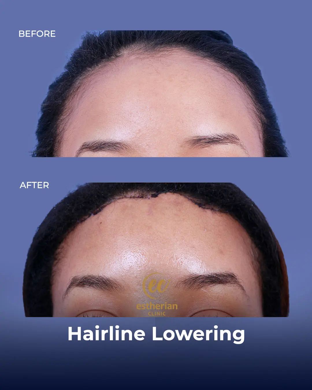Hairline Lowering Surgery Before and After Transformation by the Estherian Clinic