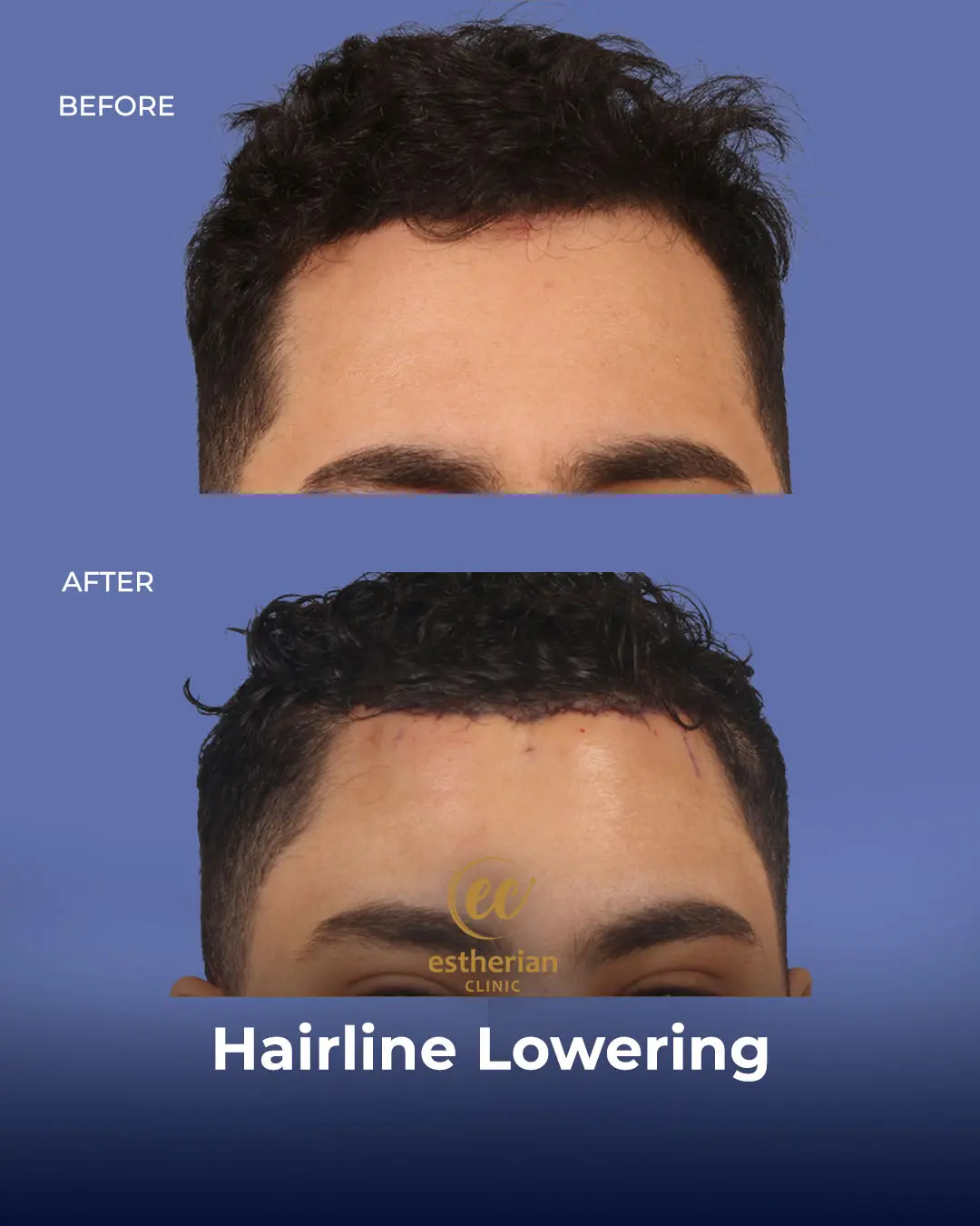 Hairline Lowering Surgery Before and After Transformation by the Estherian Clinic