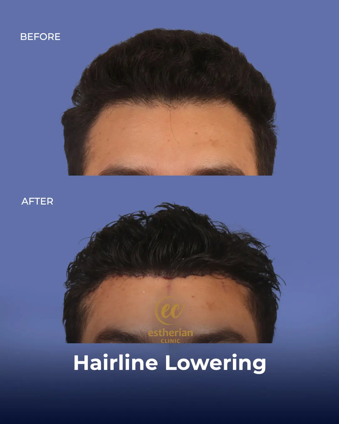 Hairline Lowering Surgery Before and After Transformation by the Estherian Clinic