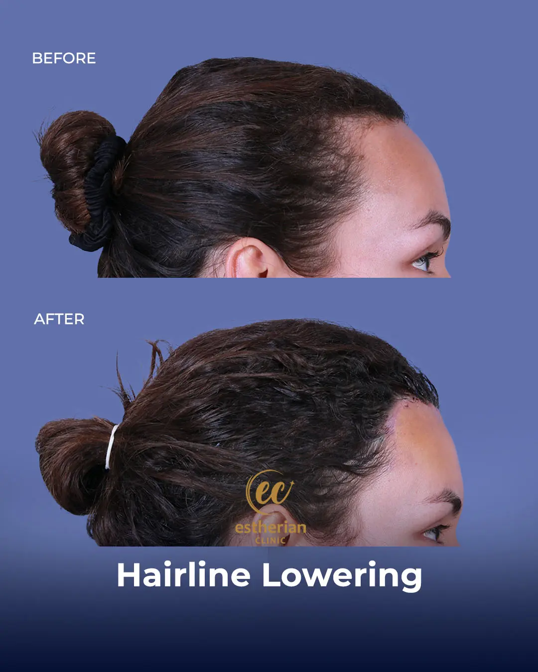 Hairline Lowering Surgery Before and After Transformation by the Estherian Clinic