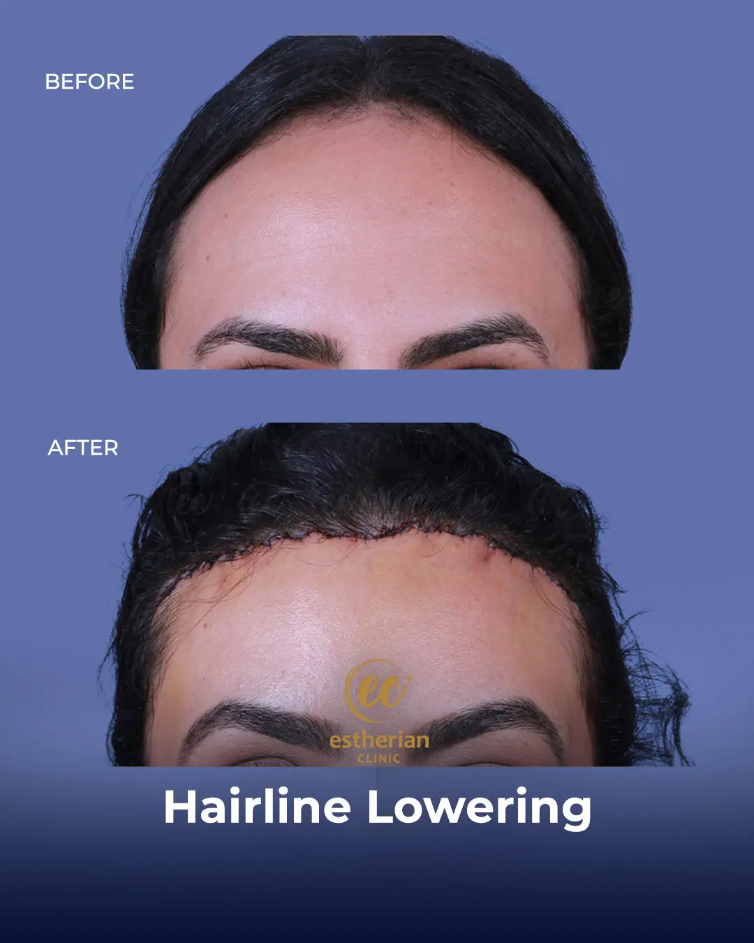Hairline Lowering Surgery Before and After Transformation by the Estherian Clinic