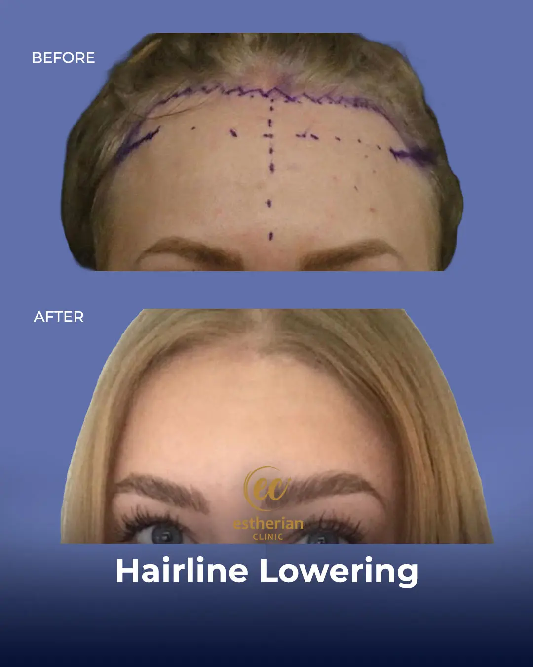 Hairline Lowering Surgery Before and After Transformation by the Estherian Clinic