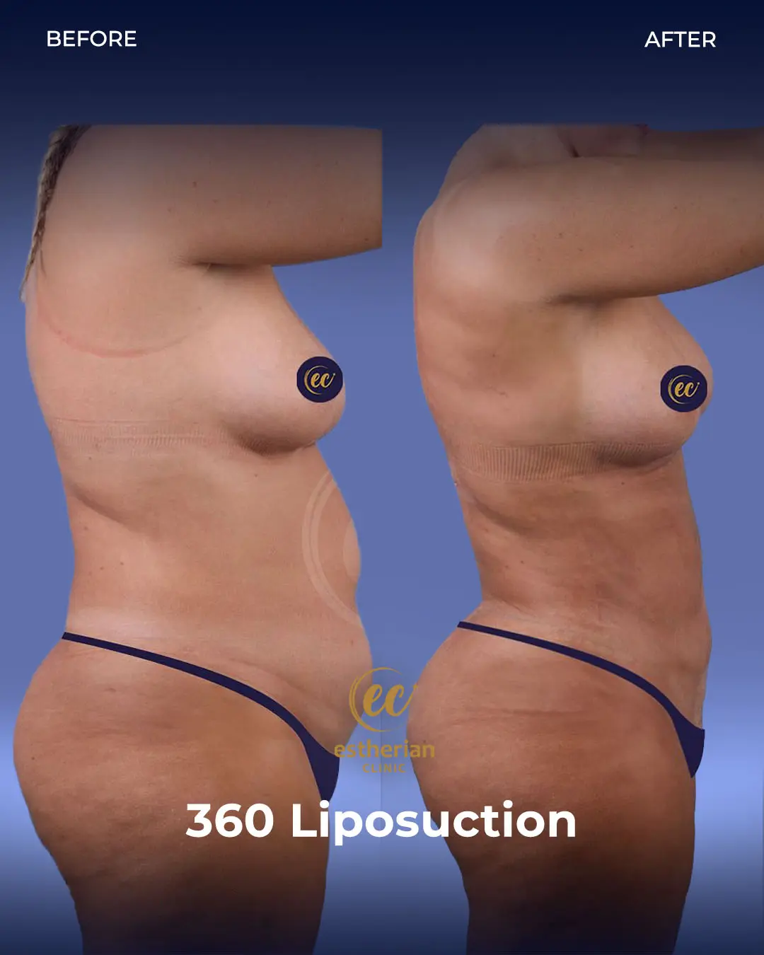Liposuction (Real patient results) by the Estherian Clinic