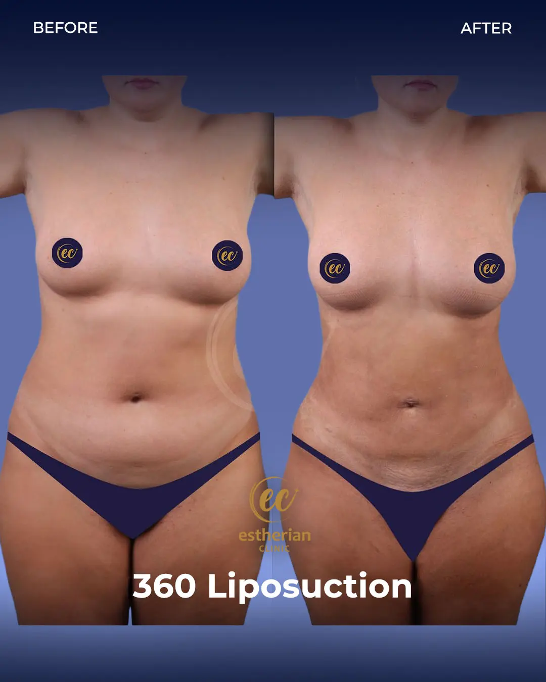 Liposuction (Real patient results) by the Estherian Clinic